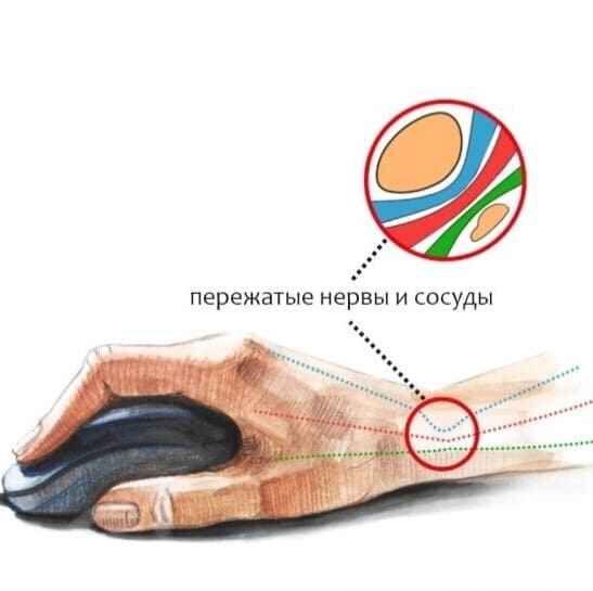 пережимается нерв на руке