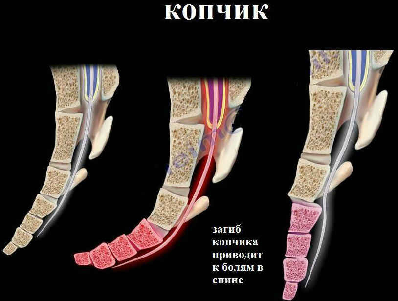 болит кобчик когда сижу